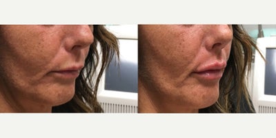 Juvederm before and after photo