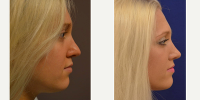 Revision Rhinoplasty before and after photo