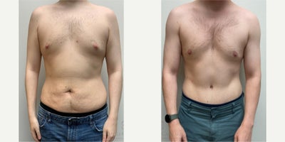 Tummy Tuck before and after photo