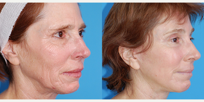 Brow Lift before and after photo