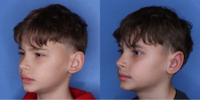 Ear Surgery before and after photo