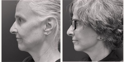 Facelift before and after photo