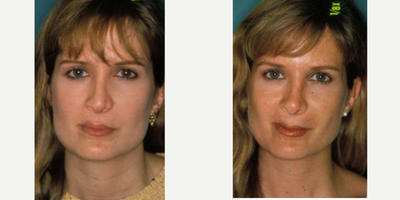 Rhinoplasty before and after photo