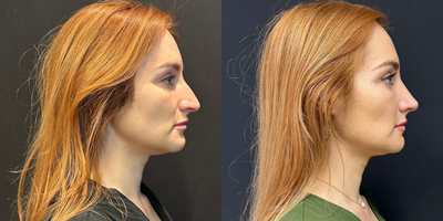 Rhinoplasty before and after photo