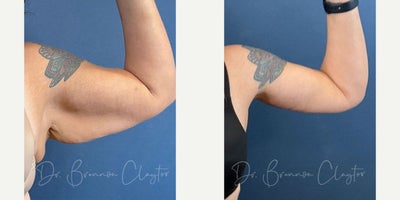 Arm Lift before and after photo