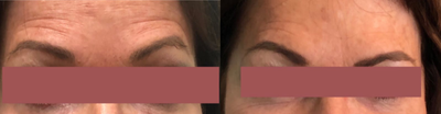 Botox before and after photo