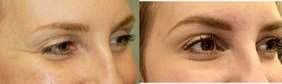 Botox before and after photo