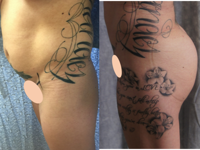 Brazilian Butt Lift before and after photo