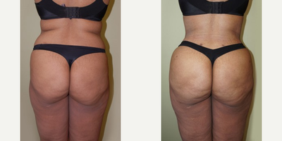 Brazilian Butt Lift before and after photo