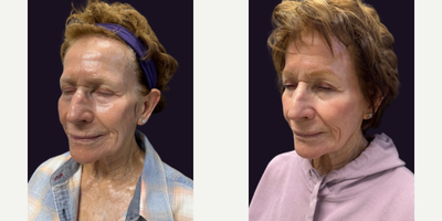 Laser Resurfacing before and after photo