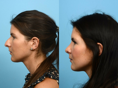 Alarplasty before and after photo