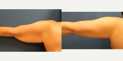 Arm Lift before and after photo