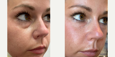 Belotero before and after photo