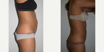 CoolSculpting before and after photo