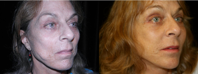 Facelift before and after photo