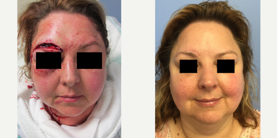 Facial Reconstructive Surgery before and after photo