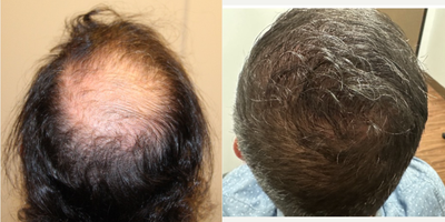 FUE Hair Transplant before and after photo