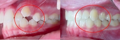 Invisalign before and after photo