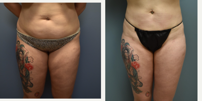 Liposuction before and after photo