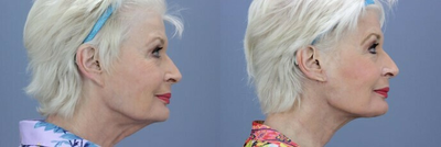 Neck Lift before and after photo
