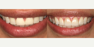 Porcelain Veneers before and after photo