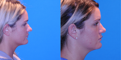 Rhinoplasty before and after photo