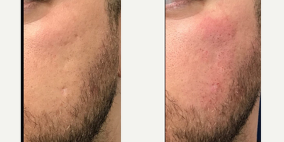 Bellafill before and after photo