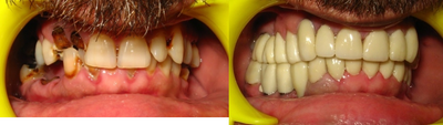 Dental Implants before and after photo