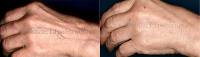 Hand Rejuvenation before and after photo