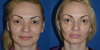 Ultherapy before and after photo