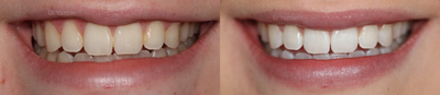 Zoom Whitening before and after photo