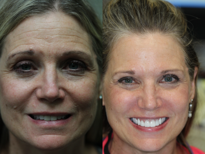 Botox before and after photo