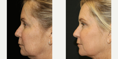 Eyelid Surgery before and after photo