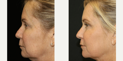 Eyelid Surgery before and after photo