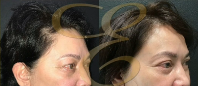 Eyelid Surgery before and after photo