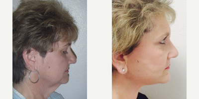 Facelift before and after photo