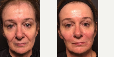 Nonsurgical Facelift before and after photo