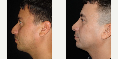 Rhinoplasty before and after photo