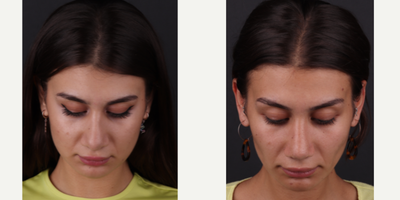 Buccal Fat Removal before and after photo
