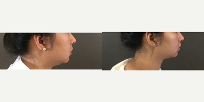 Dermal Fillers before and after photo