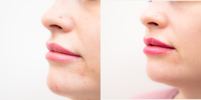 Dermal Fillers before and after photo