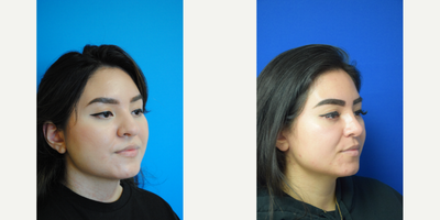 Dermal Fillers before and after photo