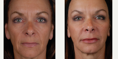Restylane before and after photo