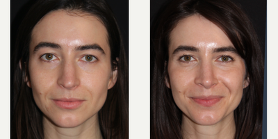 Revision Rhinoplasty before and after photo