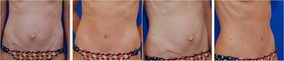 Tummy Tuck before and after photo