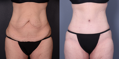 Tummy Tuck before and after photo