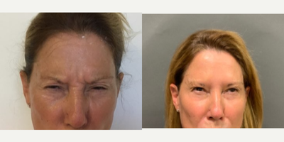 Botox before and after photo