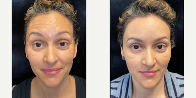 Botox before and after photo