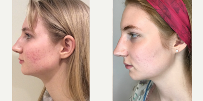 Chemical Peel before and after photo
