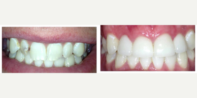 Dental Crown before and after photo
